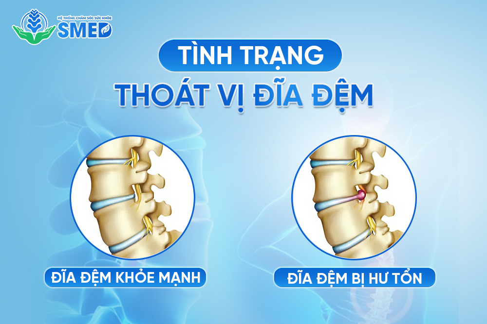 Cần phân biệt rõ tình trạng thoát vị đĩa đệm và thoái hóa cột sống
