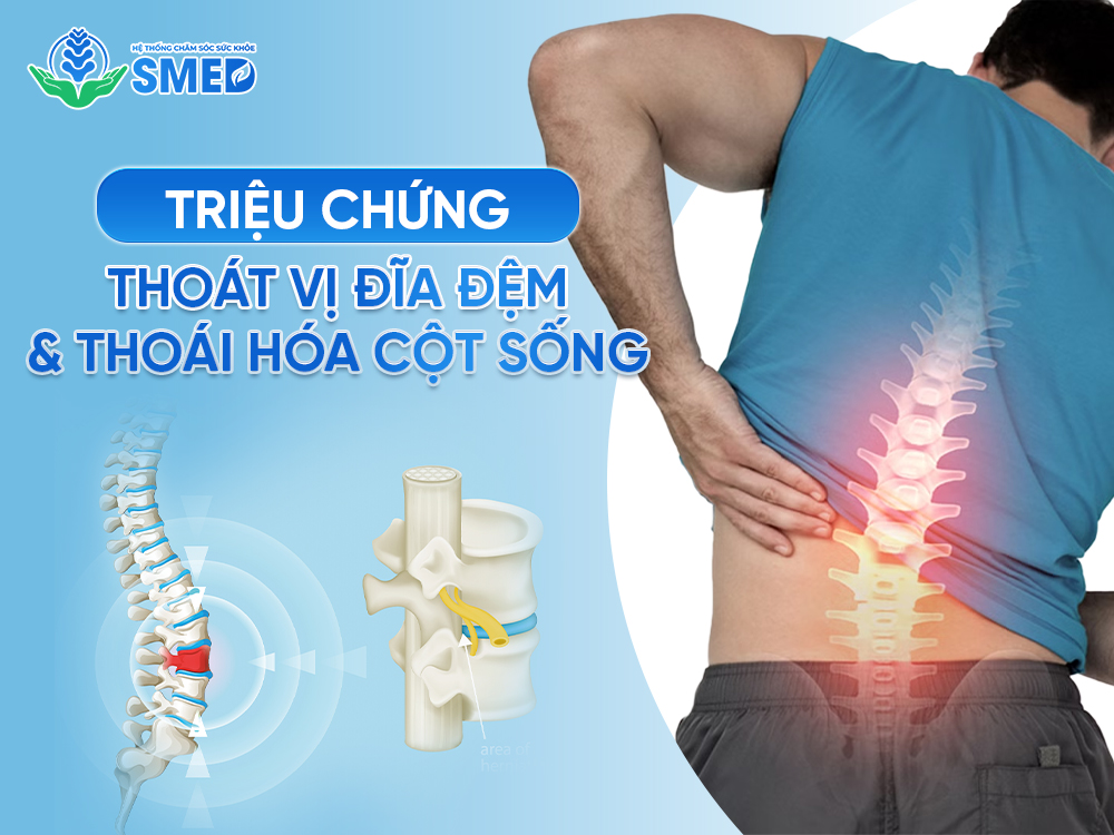Triệu chứng phổ biến của thoát vị đĩa đệm và thoái hóa cột sống 