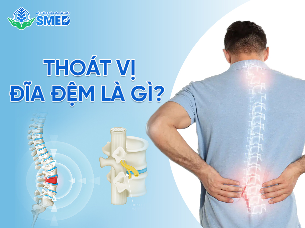 Hiểu rõ nguyên nhân sâu xa của thoát vị đĩa đệm 