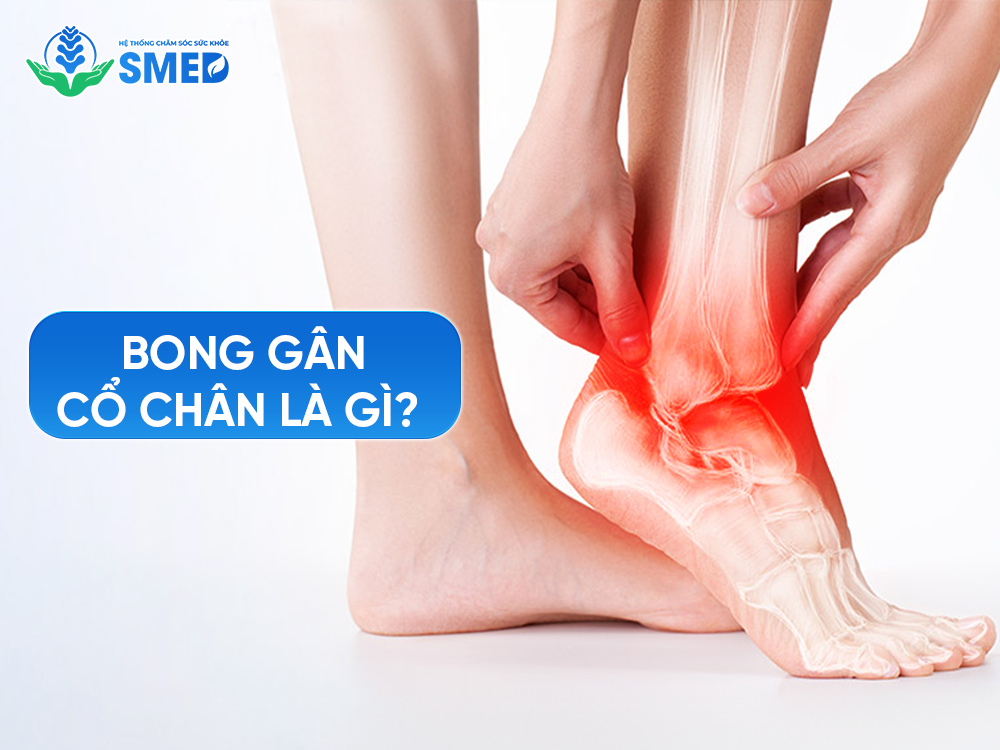 Khái niệm về bong gân cổ chân là gì?