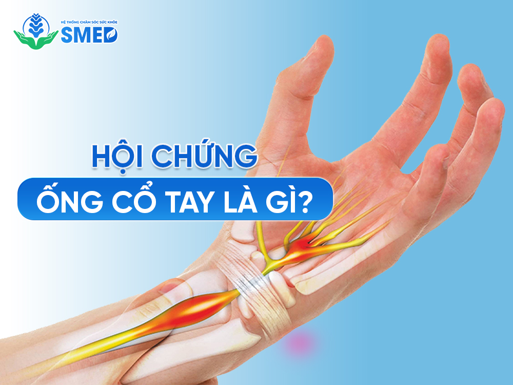 Khái niệm về hội chứng ống cổ tay 