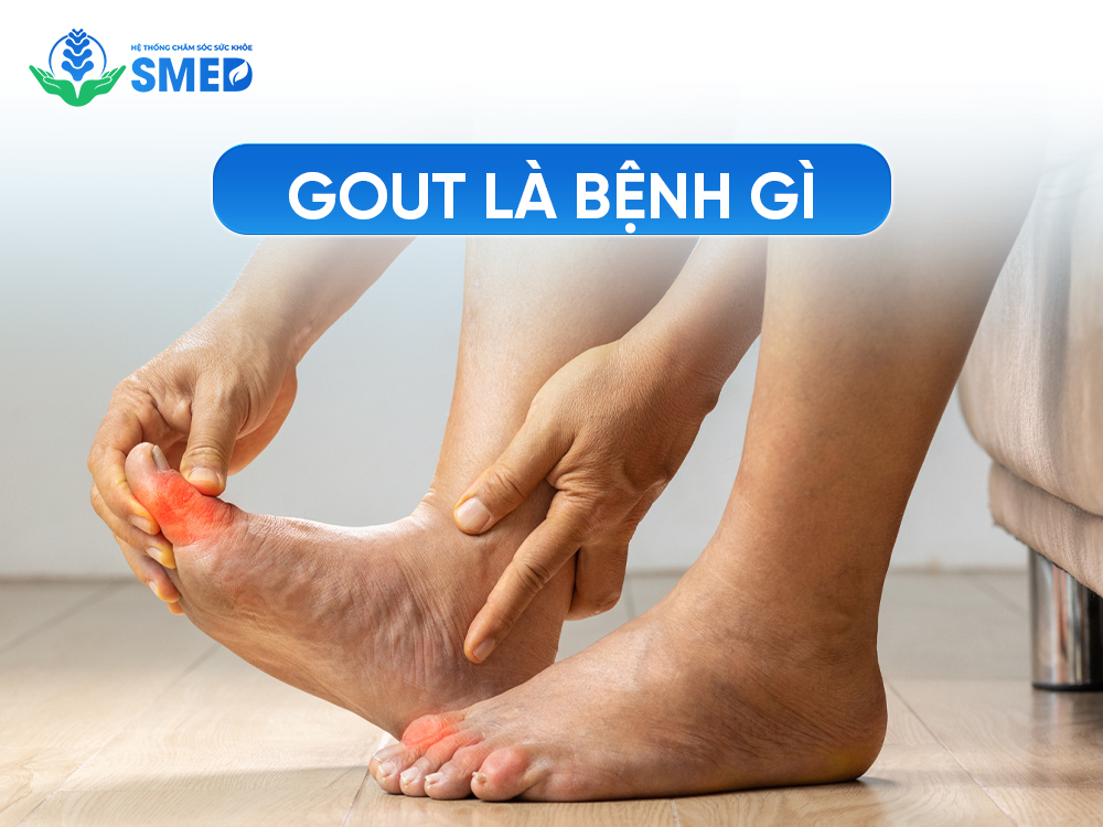 Hiểu rõ sự thật về bệnh gout 
