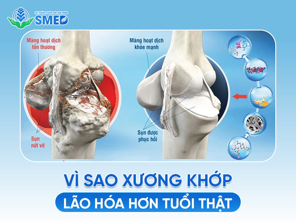 Vì sao nhiều người bị lão hóa xương khớp sớm? 