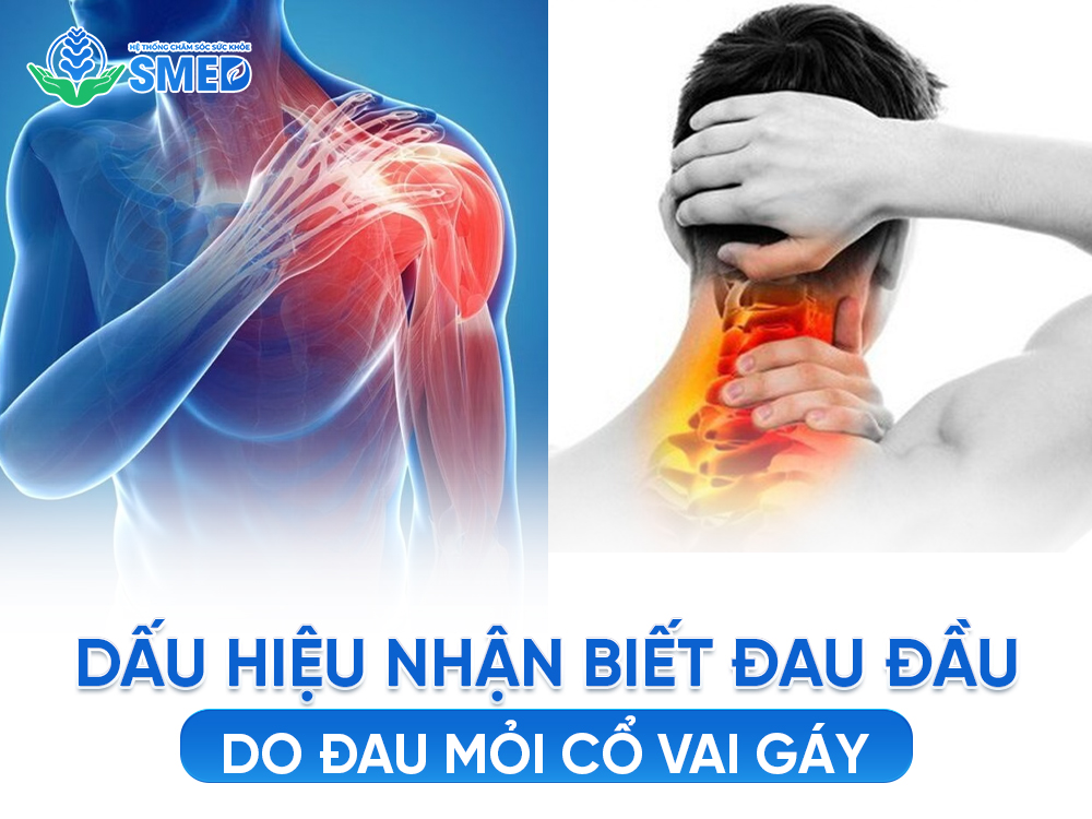 Các dấu hiệu nhận biết đau đầu do đau mỏi cổ vai gáy 
