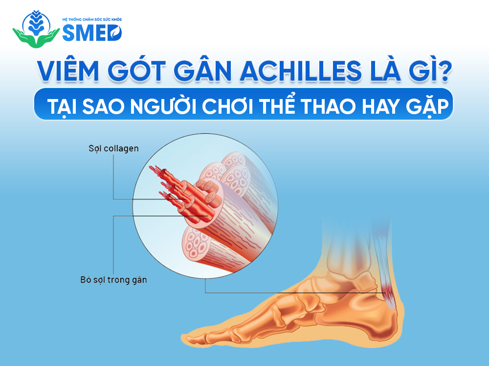 Viêm gân gót Achilles là gì? 