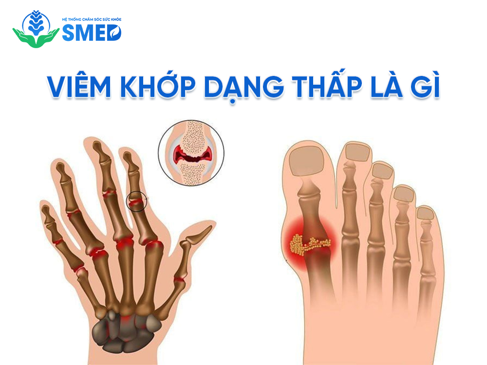 Khái niệm viêm khớp dạng thấp là gì? 