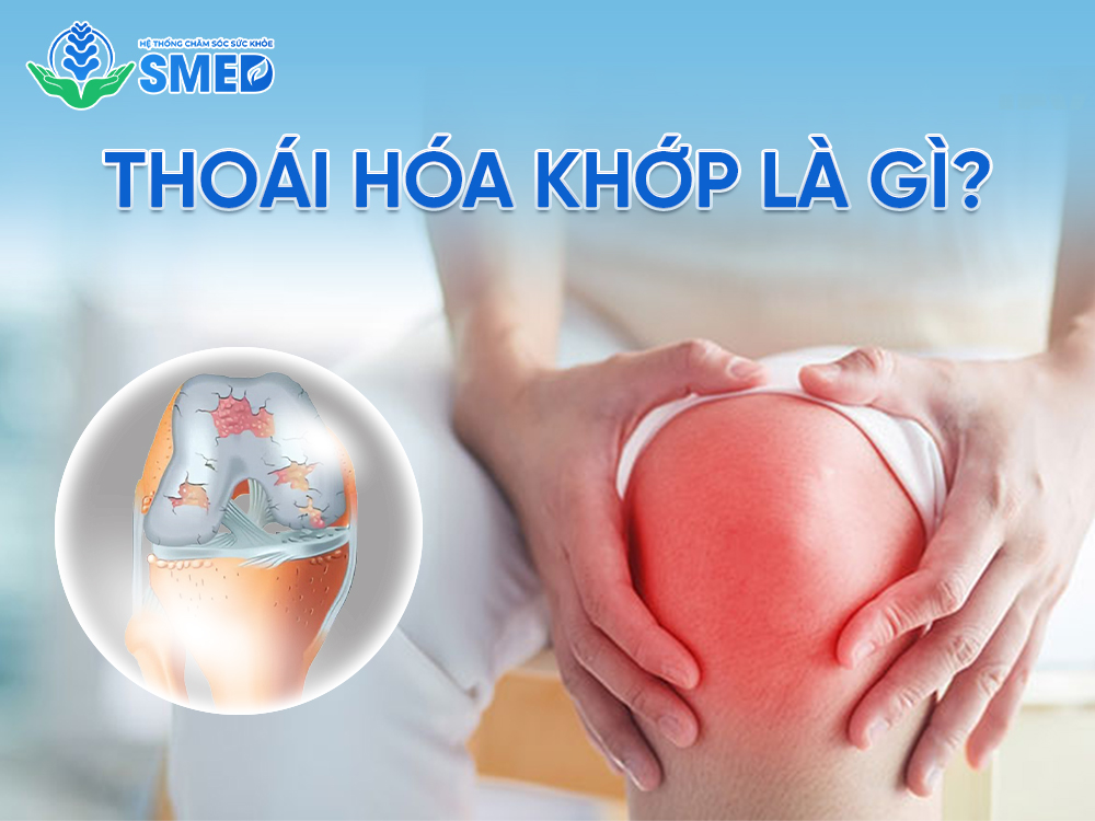 Định nghĩa thoái hóa khớp là gì? 