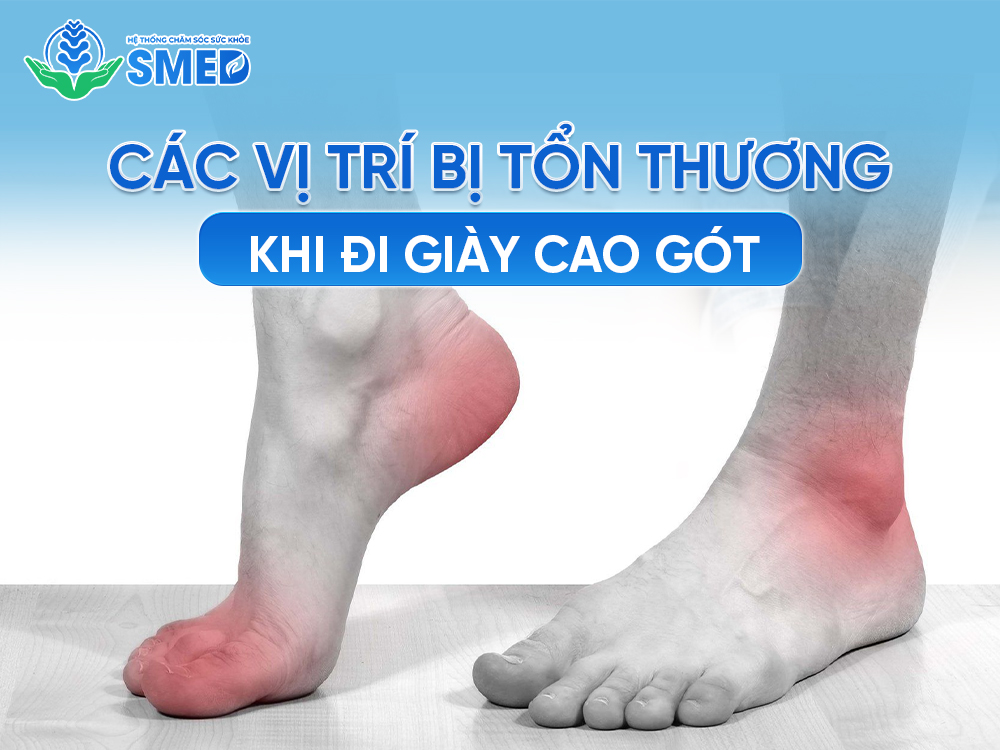 Các vị trí ở chân dễ bị tổn thương khi đi giày cao gót liên tục